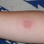 Аллергические реакции и осложнения после прививок, манту