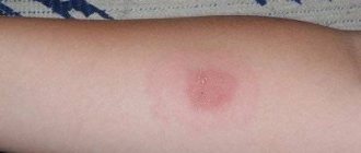 Allergic reactions and complications after vaccinations, mantoux