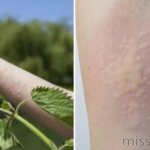 Аллергия на растения